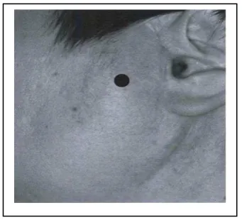 Gambar 7. Trigger point pada preaurikular 7