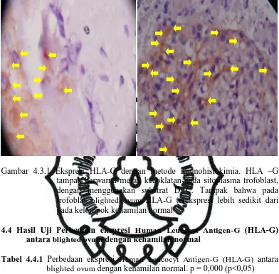 Gambar 4.3.1 Ekspresi HLA-G dengan metode imunohistokimia. HLA –G  tampak berwarna merah kecoklatan pada sitoplasma trofoblast, 