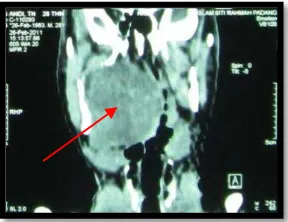 Gambar 4. Tomografi komputer orofaring potongan koronal sebelum operasi 