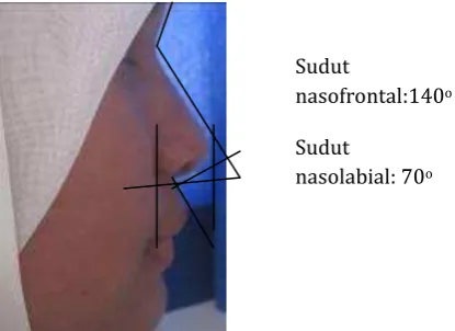Gambar 2. Rontgen sinus paranasal dan os nasal.   