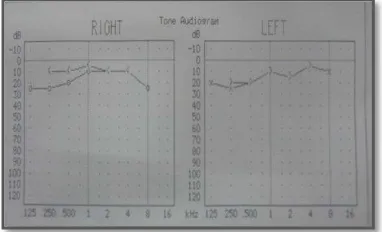 Gambar 5 : Audiometri pasien 7 minggu pasca miringoplasti  