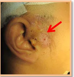 Figure 3 : A)The right infected preauricular sinus,  B) A small dell at the cymba concha of left auricle