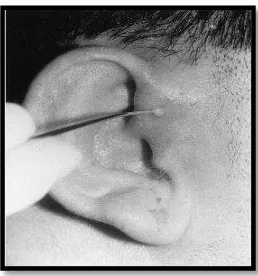 Figure 10 : lacrimal probe is entered to the infected preauricular sinus allowing the release of pus.22 