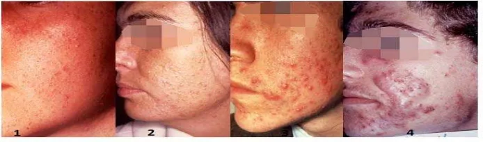 Gambar 1. Gambaran klinis acne vulgaris 