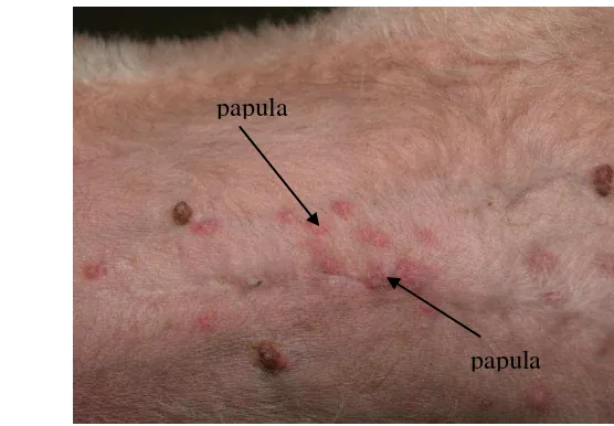 Gambar 5  Papulae pada gejala awal skabies  