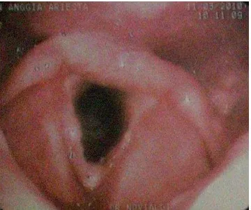 Gambar 7.  Hasil pemeriksaan laringoskopi serat optik (11 Maret 2010) tidak tampak gambaran massa pada epiglotis, plika vokalis dan aritenoid  