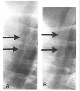 Gambar 6: Gambaran radiologis trakeomalasia21 