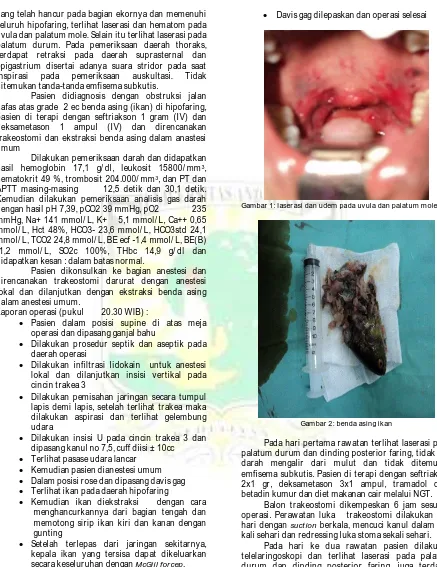 Gambar 1: laserasi dan udem pada uvula dan palatum mole   
