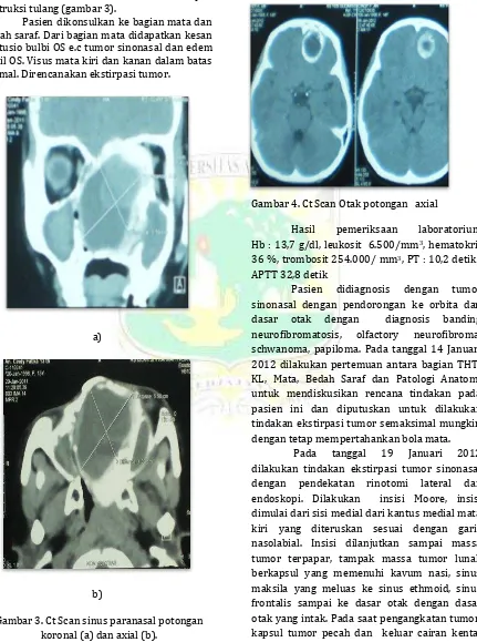 Gambar 3. Ct Scan sinus paranasal potongan koronal (a) dan axial (b). 