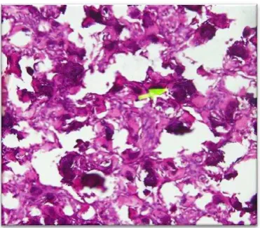 Gambar 6. Gambaran psammoma bodies 