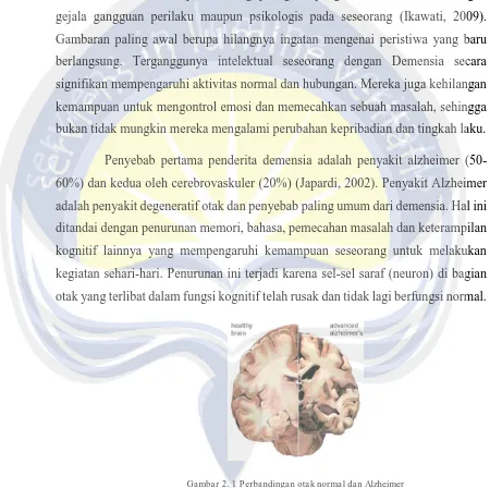 Gambar 2. 1 Perbandingan otak normal dan Alzheimer 