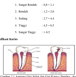 Gambar 2.1 Anatomi Gigi Sehat dan Gigi Karies (Sumber : desa  