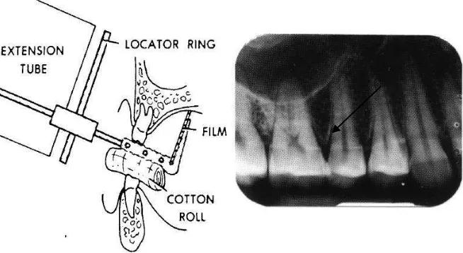 Gambar 7. Teknik Bite Wing pada gigi posterior 