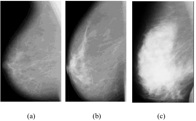 Gambar 2.1 Citra mammografi untuk payudara normal (a), tumor payudara  jinak (b), dan tumor payudara ganas (c)  