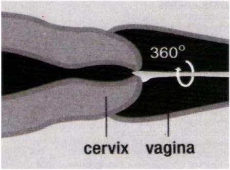 Gambar 2.8 Cara mengambil sampel Tes Pap dengan spatula kayu  