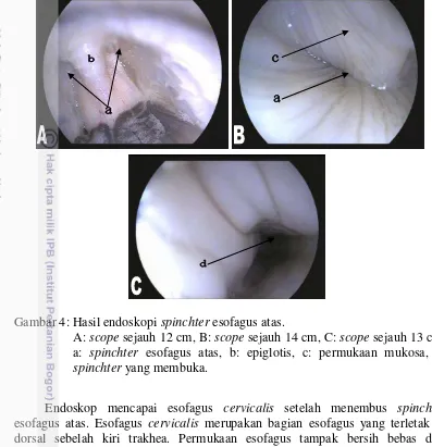 Gambar 4: Hasil endoskopi spinchter esofagus atas.  