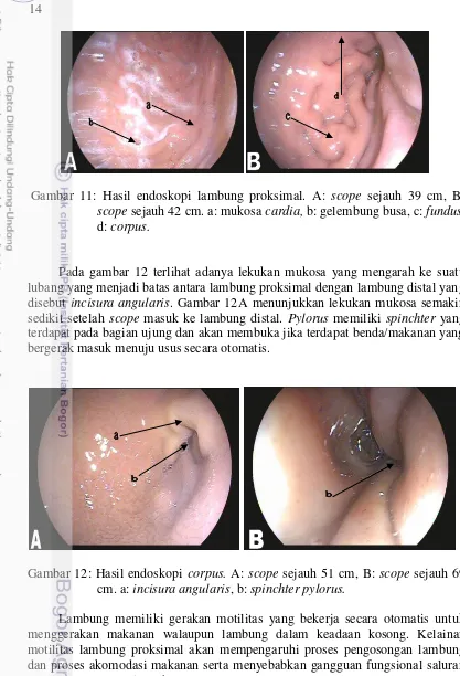 Gambar 12: Hasil endoskopi corpus. A: scope sejauh 51 cm, B: scope sejauh 69 