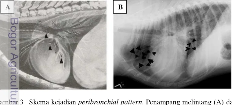 Gambar 3 Skema kejadian peribronchial pattern. Penampang melintang (A) dan 