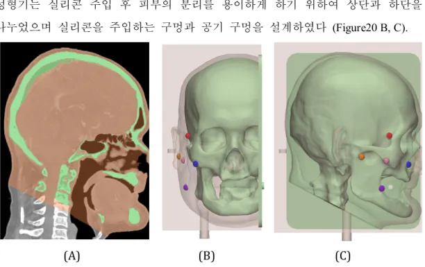 Figure 20. Visualization of segmented anatomies including the skin and skull, and the modeled in- in-vitro phantom in CT images of a 59-year-old patient with malignant melanoma