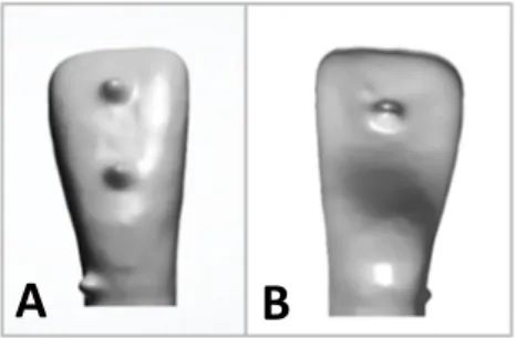 Fig. 3  Reference  cones  were  merged  on  the  labial  and  lingual  side  of  the  right  mandibular central incisor crown