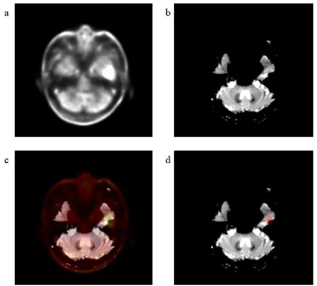 Figure 2. Representative images of quantitative analysis of MR parameters. a  18 F-FDOPA PET image, b  Baseline T2 MR image for parametric MR map, c Coregistered  18 F-FDOPA PET image on baseline  T2 MR, d VOI centered at the point of maximum  18 F-FDOPA u