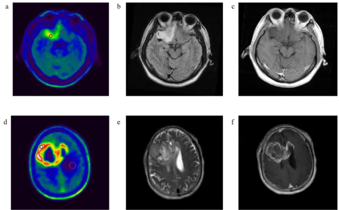 Figure 4. Representative cases showing VOIs on  18 F-FDOPA PET and MR images of low grade 