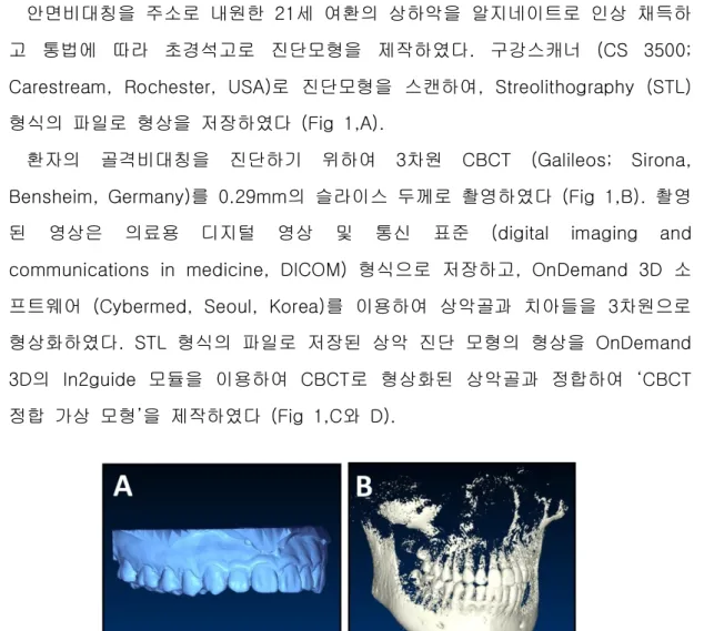Fig  1.  Image  of  a  maxillary  diagnosis  model  saved  as  a  STL  file  (A)  and  maxilla-mandibular  image  produced  by  CBCT  (B)