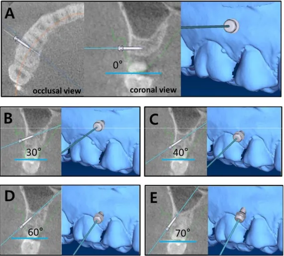 Fig  2.  In  'In2guide',  virtual  orthodontic  mini-implants  were  placed  at  0  (A),  30  (B),  40  (C),  50  (D),  and  70  (E)  degree  angles  to  the  occlusal  surface  between  the  maxillary  right  second  premolar  and  first  molar.
