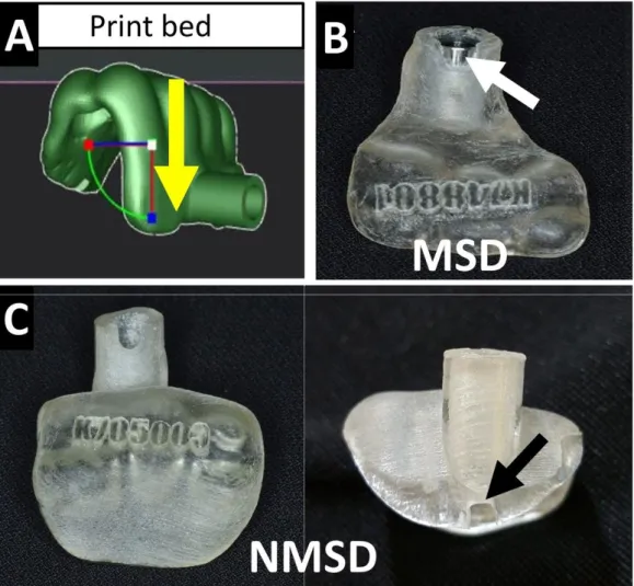 Fig  3.  Orthodontic  mini-implant  surgical  guides  :  A,  build  direction  of  digital  light  processing  printer;  B,  metal  sleeve  design  surgical  guide  (MSD); 