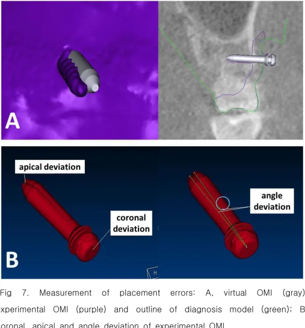 Fig  7.  Measurement  of  placement  errors:  A,  virtual  OMI  (gray),  experimental  OMI  (purple)  and  outline  of  diagnosis  model  (green);  B,  coronal,  apical  and  angle  deviation  of  experimental  OMI.