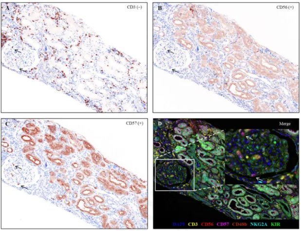 Figure 1. Representative  multiplex immunohistochemistry of a kidney allograft with T  cell -mediated rejection and antibody-mediated rejection