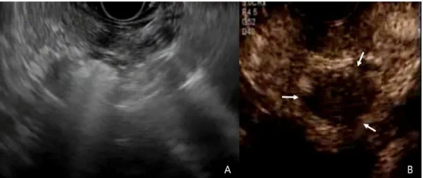 Fig. 2. Imaging of EUS-guided radiofrequency ablation and follow-up contrast-enhanced EUS
