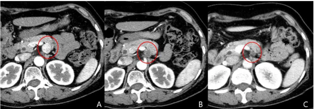 Fig. 3. A, The abdominal CT showing a 19-mm hyperenhancing neuroendocrine tumor in the  body of the pancreas (red circle)
