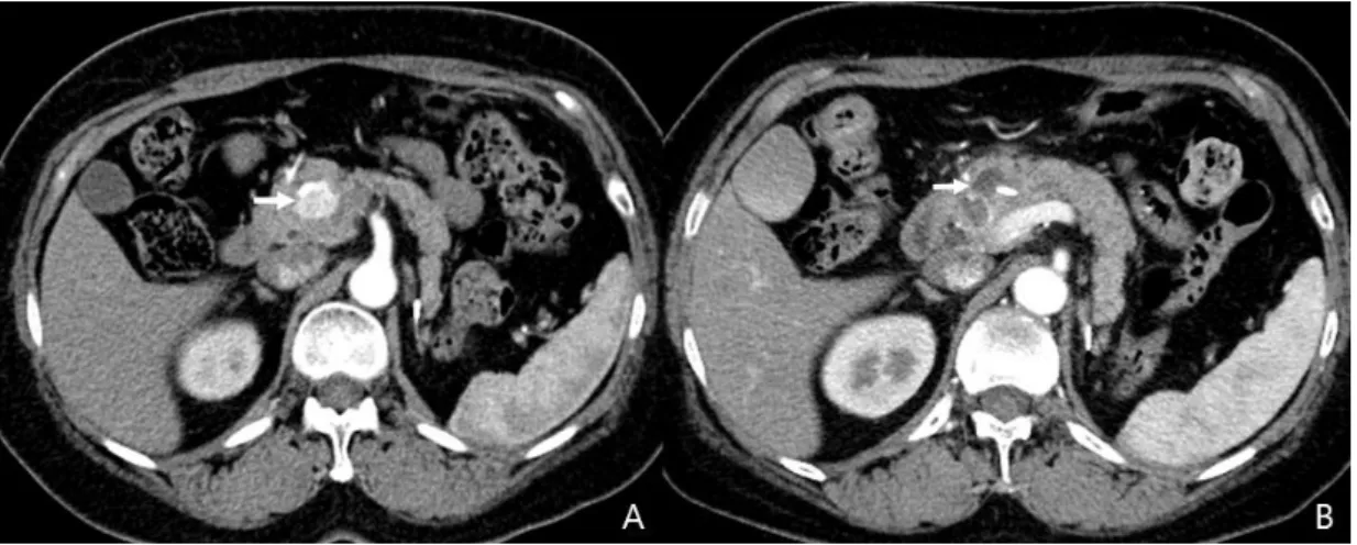 Fig. 5. A, The abdominal CT image obtained before ablation shows a 2.3-cm neuroendocrine  tumor in the head of pancreas (white arrow)