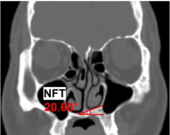 Figure 1. Measurement of the Nasal Floor Tilting (NFT). On a coronal image of the OMU  CT image, the most inferior point of the bony nasal floor in each nasal cavity were marked