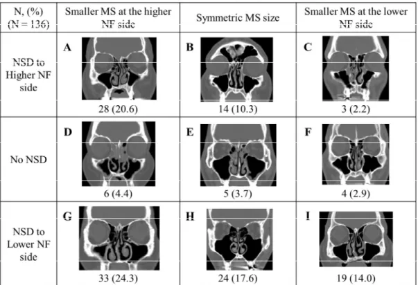 Figure  5.  Anatomical  Relation  of  the  Bony  Nasal  Septum  and  the  Maxillary  Sinus  in  Patients  with  Nasal  Floor  Tilting  (N  =  136)