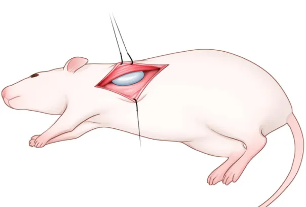 Figure  2. 수술 요약.  광배근을 보형물을 넣을 수 있게 일부 들어올린 후 보형물을 아래로 위치 시킨다.
