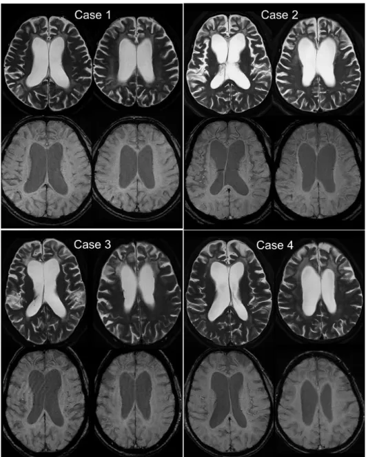 Figure 4.1.1 T 2 -weighted images and Susceptibility-weighted images on ALSP cases. In all ALSP cases,  T 2 -weighted  images  shows  symmetric  bifrontal  white  matter  hyperintensities  with  sparing  of  the  subcortical U fibers and frontal-predominan