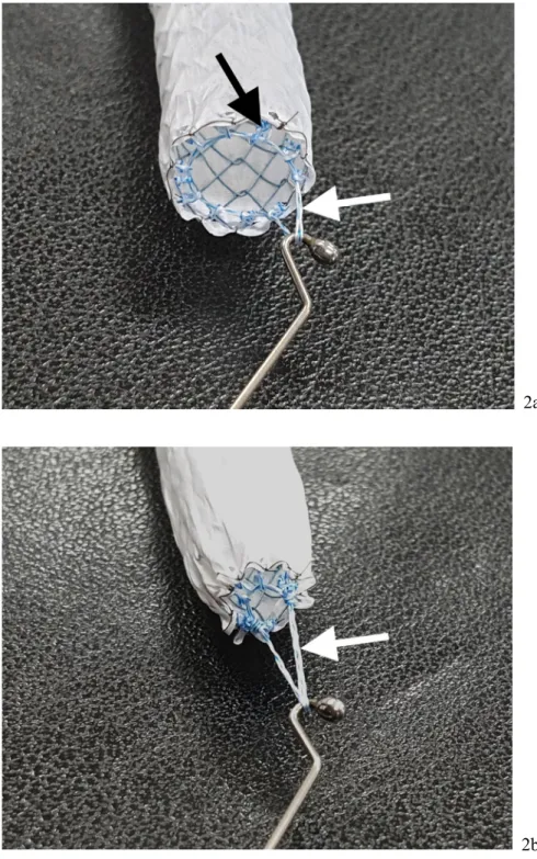 Figure 2: Retrievable covered stent and retrieval hook wire used in the procedures. (a) “End on” view  of  the  proximal  end  of  the  retrievable  covered  stent