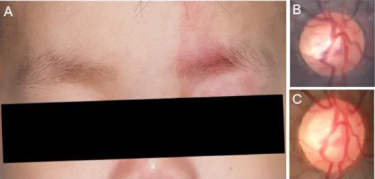 Figure 2. Representative case of the SWS-associated unilateral  glaucoma patient with fellow eye involvement