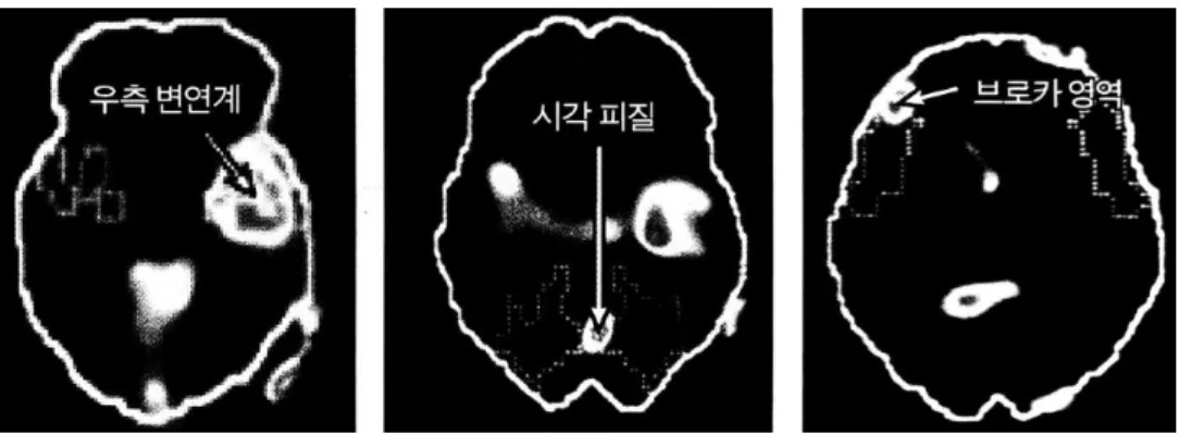[그림  2]  트라우마가  떠오른  뇌의  스캔  사진 98