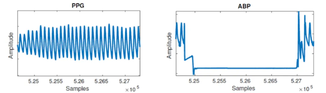 Figure 3.1: 원본 ABP 신호에서 발견되는 평평한 신호 잡음[4]
