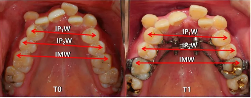 Fig. 1. Changes in maxillary dental arch width before (T0) and after (T1) MARPE. IP1W, inter-first premolar width; IP2W, inter-second  premolar width; IMW, inter-first molar width.