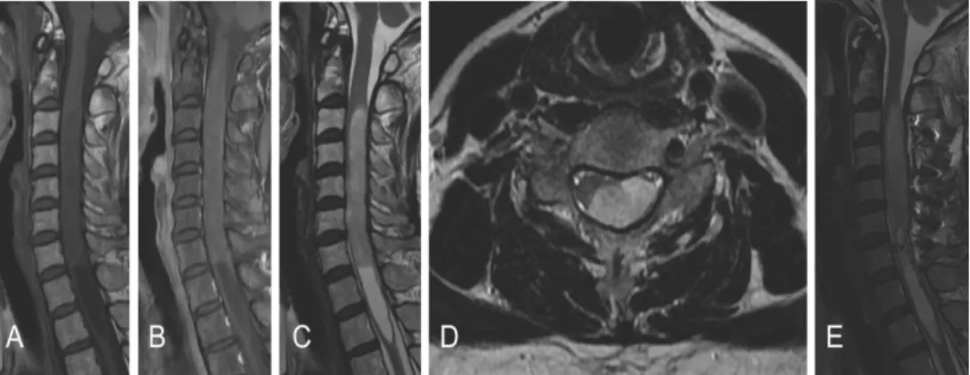 Fig 1. Preoperative magnetic resonance images of patient #9 showing an  intramedullary mass located at the C2-7 level with associated hydrosyrinx  extending to T3 level