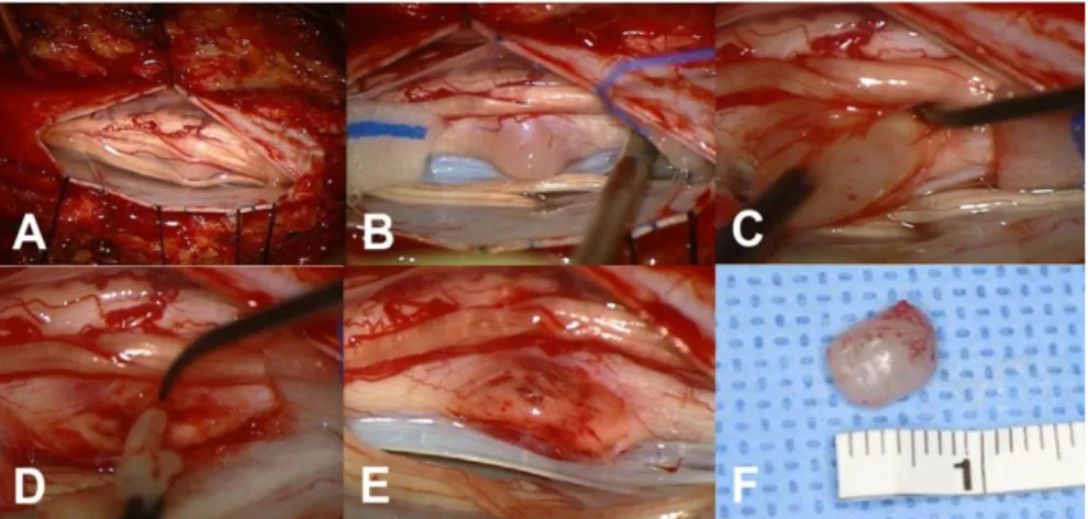 Fig 6. Intraoperative photograph of patient #6. A, B After durotomy the  exophytic tumor was seen among the rootlets at the left lateral aspect of the  spinal cord