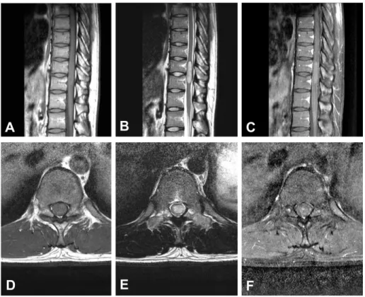 Fig 7. Preoperative magnetic resonance images of the patient #8 showing an  intramedullary mass located at the T10-11 level