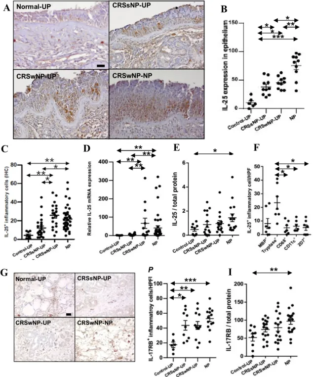 Figure 5. Expression of IL-25 and IL-17RB in CRS. (A) Representative immunostaining for IL-25  (B) Number of IL-25 +  epithelial cells per 100 cells  (C) Number of IL-25 +  inflammatory cells (HPF; 