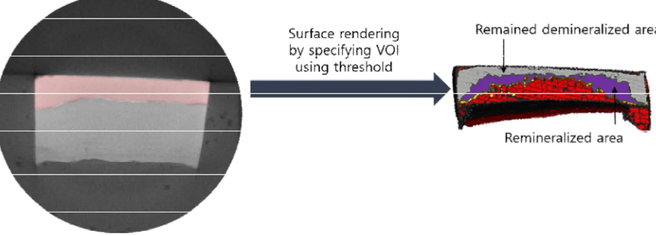 Fig. 3. The difference of volume was measured by superimposing the 3D images obtained before and after remineralization.