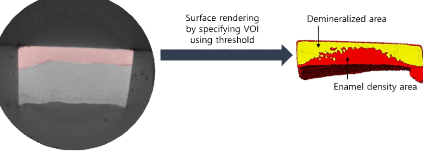 Fig. 2. The 3D image was formed by surface rendering through the thresold setting corresponding to enamel and demineralization lesion, which is the ROI to measure the volume of the tomographic images obtained using μCT.