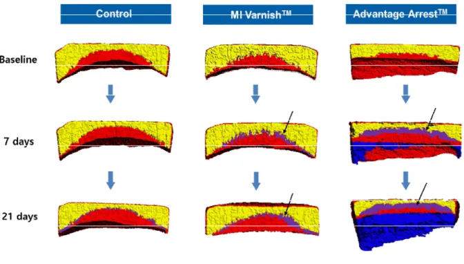 Fig. 5. Comparison of internal mineral density. The remineralization zone recovered to nomal mineral density (purple) of the Advantage Arrest ™ group was larger than that of MI Varnish ™ group